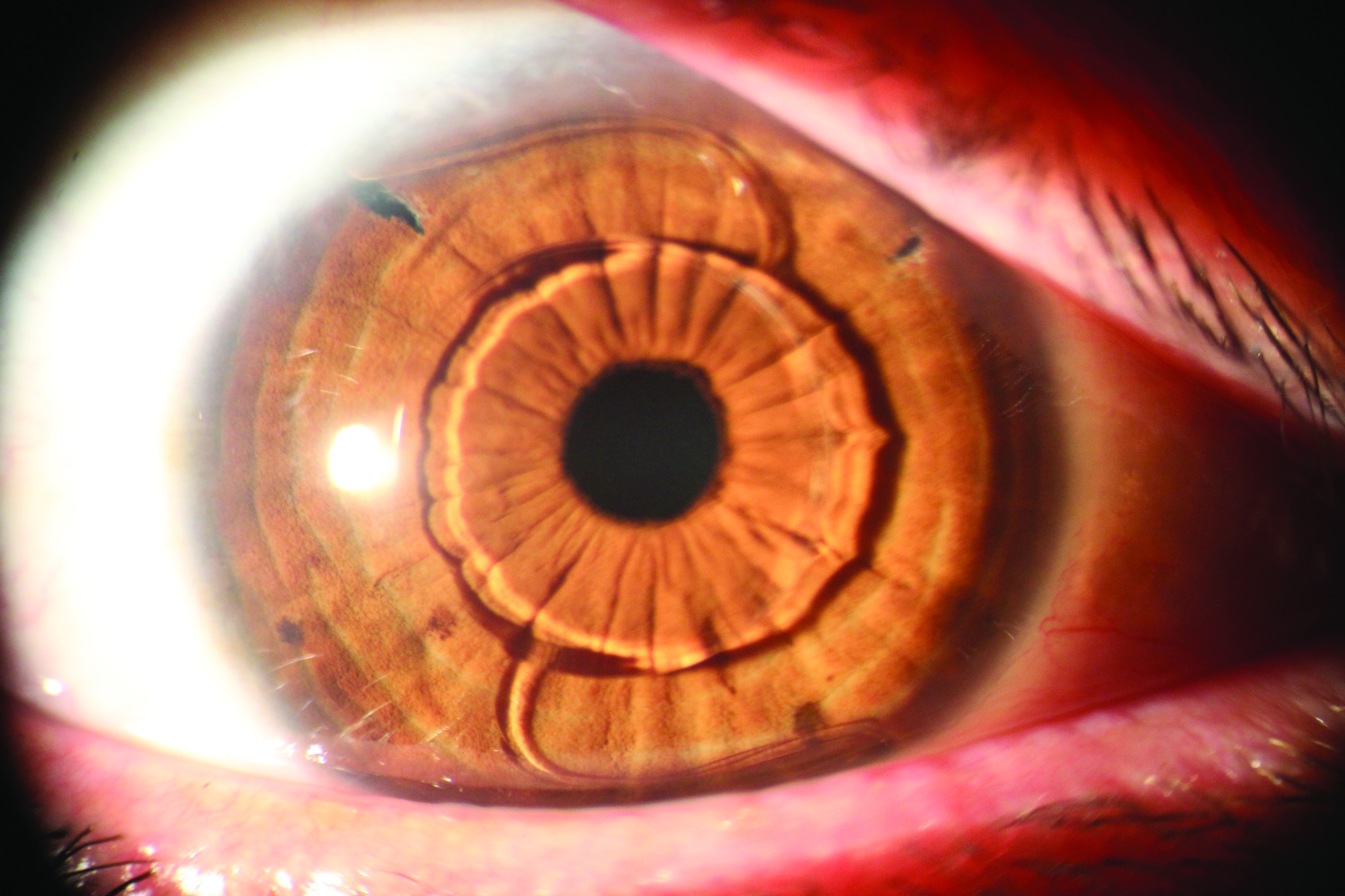 Lente intraocular 2025 de camara anterior